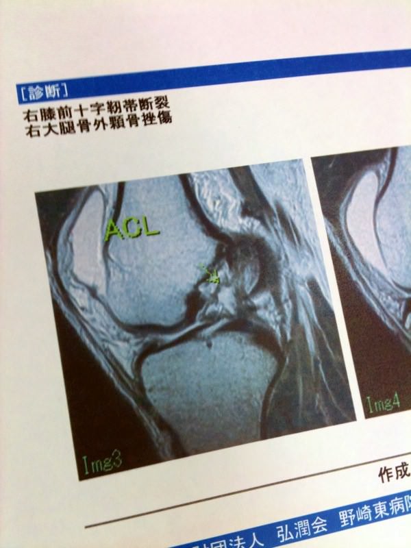 右膝前十字靭帯断列